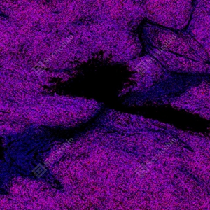 12 GB150126_CD1a_red_mAb126_mAb12625070302 d7000 H thymoma_5.0x_IF_WM.jpg