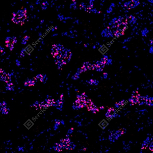 11 YB151304_Topoisomerase II alpha_red_mAb123_mAb12325082602 d500 H breast cancer_10.0x_IF_WM.jpg