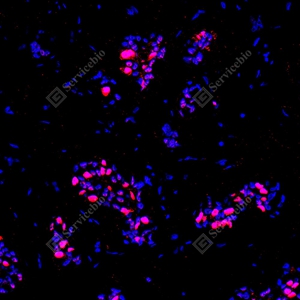 12 YB151304_Topoisomerase II alpha_red_mAb123_mAb12325082602 d500 H breast cancer_20.0x_IF_WM.jpg