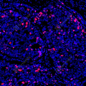 15 YB151304_Topoisomerase II alpha_red_mAb123_mAb12325082602 d500 H gastric carcinoma_20.0x_IF_WM.jpg