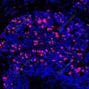 16 YB151304_Topoisomerase II alpha_red_mAb123_mAb12325082602 d500 H gastric carcinoma_24.0x_IF_WM.jpg