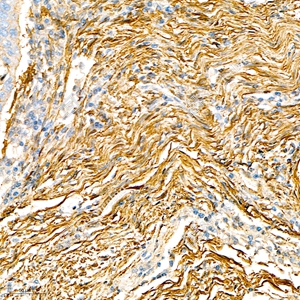 02 GB111364_alpha smooth muscle Actin_4944_d800_H lung cancer_26.4x_IHC_WM.jpg