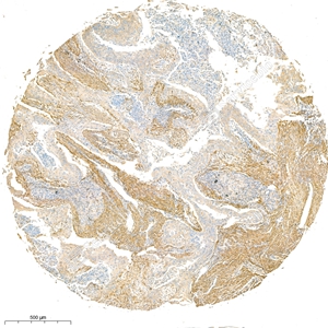 03 GB111364_alpha smooth muscle Actin_4944_d800_H lung cancer_3.9x_IHC_WM.jpg