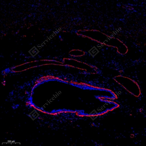 07 GB111364_alpha smooth muscle Actin_red_4944_d600_H breast cancer_5.8x_IF_WM.jpg