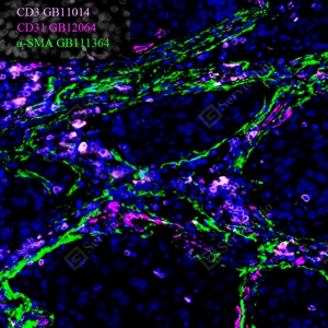 12 GB12064 H lung cancer -SMA（绿）GB111364+CD31（玫红）GB12064+CD3(粉）GB11014 三标_20.0x_IF_WM.jpg