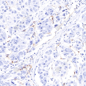 1 GB12086_eNOS_4F2H6 d1000 H liver cancer_40.0x_IHC_WM.jpg
