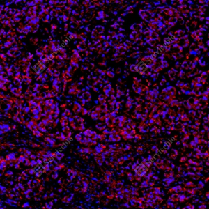 11 GB15847_Keap1_red_D01820_D0182025091601 d100 H colon cancer_15.0x_IF_WM.jpg