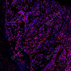 12 GB15847_Keap1_red_D01820_D0182025091601 d100 H colon cancer_10.0x_IF_WM.jpg