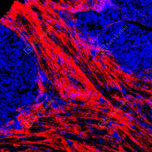 14 GB155707_Collagen I_red_D01757_D0175725090201 d500 H endometrial cancer_10.0x_IF_WM.jpg