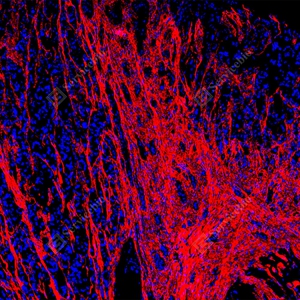 19 GB155707_Collagen I_red_D01757_D0175725090201 d1000 H colon cancer_10.0x_IF_WM.jpg