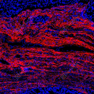 20 GB155707_Collagen I_red_D01757_D0175725090201 d1000 H endometrial cancer_10.0x_IF_WM.jpg