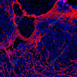 21 GB155707_Collagen I_red_D01757_D0175725090201 d500 H colon cancer_5.0x_IF_WM.jpg