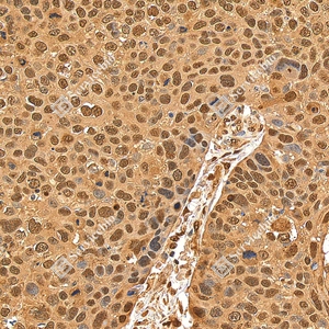 1 GB155700 20260106_Ubiquitin_D01999_D0199925111901_ d1500_ H esophageal carcinoma_30.0x_IHC_WM.jpg
