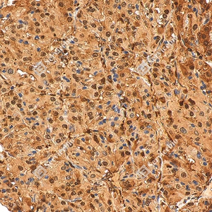 4 GB155700 20260106_Ubiquitin_D01999_D0199925111901 _d1500 _H renal carcinoma_30.0x_IHC_WM.jpg